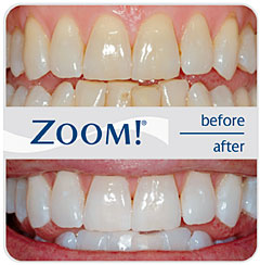 before and after results of professional teeth whitening with Zoom! Whitening, cosmetic dentistry Lawrenceville, GA dentist 