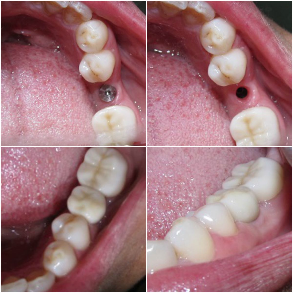 Dental Implant Procedure Sterling Heights, MI