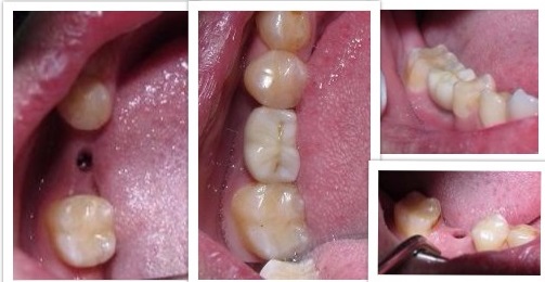 Sterling Heights Dental Implant