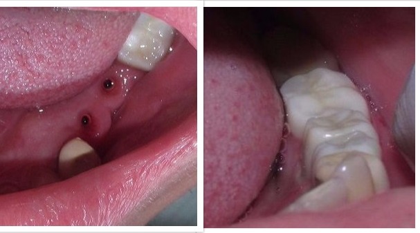 Dental Implant Sterling Heights