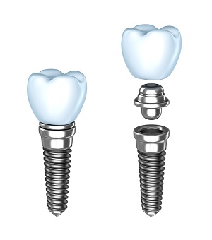 assembly of Dental Implants Sterling Heights, MI