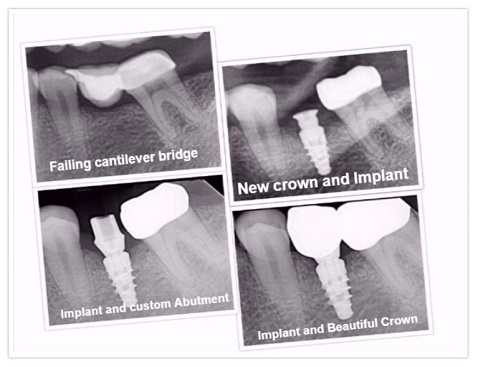 Dental Implants in Sterling Heights, MI