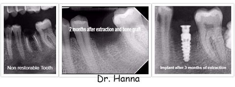 Sterling Heights, MI Dental Implants