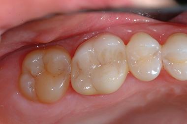 Dental Crowns Bellevue Dental Excellence