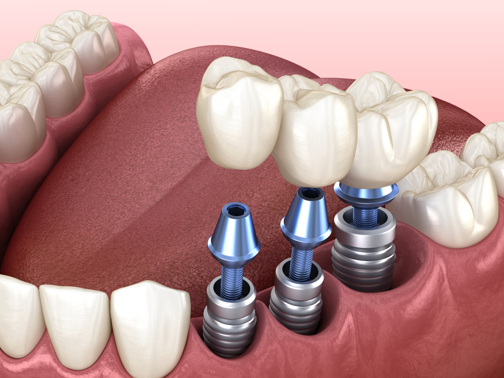 Dental Implants in Flint MI