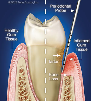 Gum Disease Treatment in Flint, MI