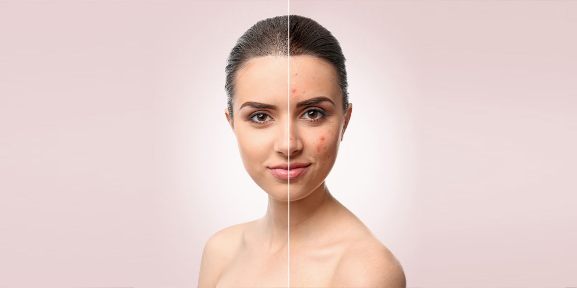 woman with clear skin vs. acne