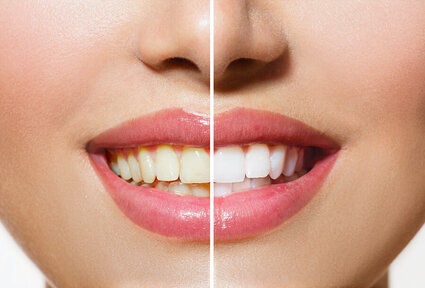 split image of woman's face, showing before after results of teeth whitening Edison, NJ cosmetic dentistry