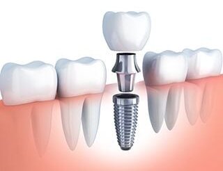 illustration of dental implant being assembled to replace missing tooth, dental implants Edison, NJ implant dentistry