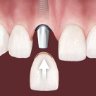 Dental Implants Pensacola