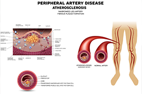 Peripheral Vascular Intervention