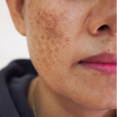 Melasma