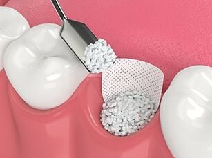 illustration of bone grafting on tooth before implant placement, dentist Sherman Oaks, CA dental implants illustration of bone grafting on tooth before implant placement, dentist Sherman Oaks, CA dental implants