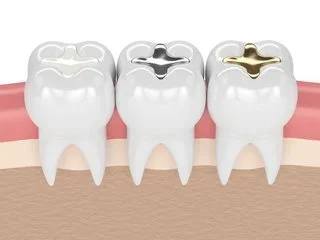 illustration of three teeth each with a different type of dental filling, dentist Sherman Oaks, CA dental filling illustration of three teeth each with a different type of dental filling, dentist Sherman Oaks, CA dental filling