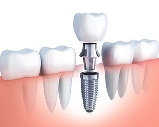 illustration of dental implant parts and assembly replacing missing tooth, dental implants Sherman Oaks, CA dentist illustration of dental implant parts and assembly replacing missing tooth, dental implants Sherman Oaks, CA dentist
