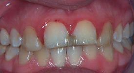 Before Teeth Whitening 2