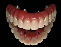 dental implants  