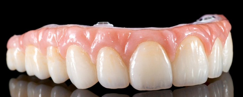dental implant temporary acrylic bridge