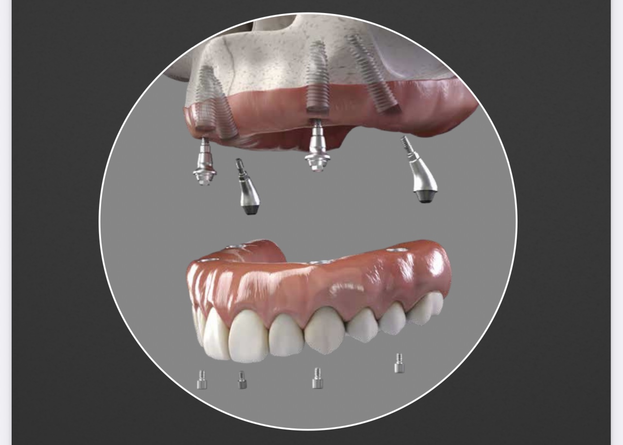 implantes dentales fort lauderdale
