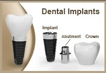implantes dentales precio fort lauderdale