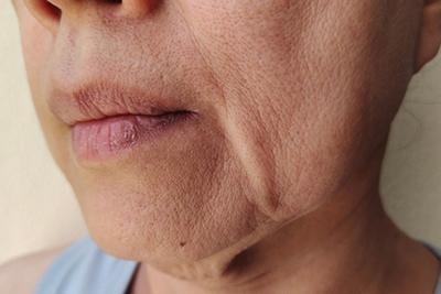 Sagging-Skin-in-Palm-Coast-Ormond-Beach-And-Port-Orange-FL