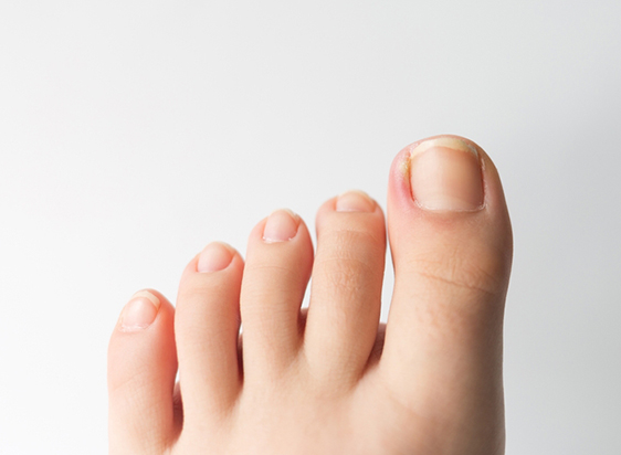 Ingrown-Toenail-Treatment-in-Fort-Dodge-Lake City-and-Humboldt-IA