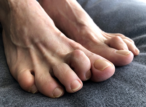 Hammertoe-Treatment-in-Fort Dodge-IA