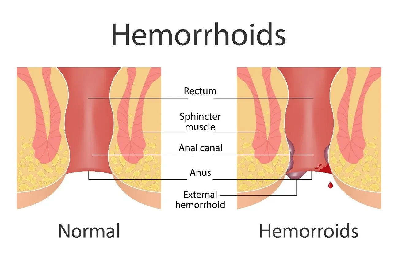 hemorrhoid